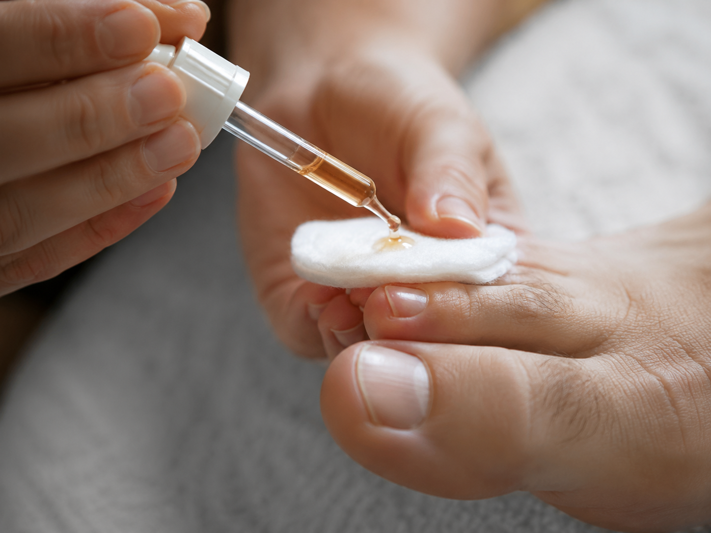 Teebaumöl gegen Nagelpilz – Anwendung auf dem Nagel