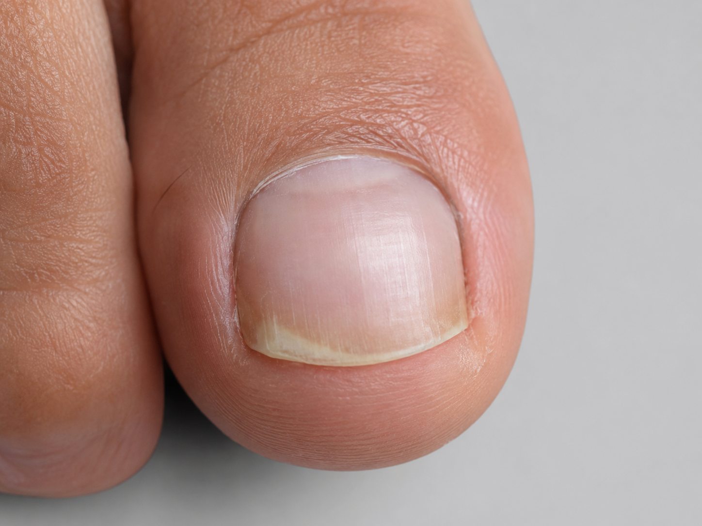 Frühe Zeichen Nagelpilz – kleiner heller Fleck am Nagelrand