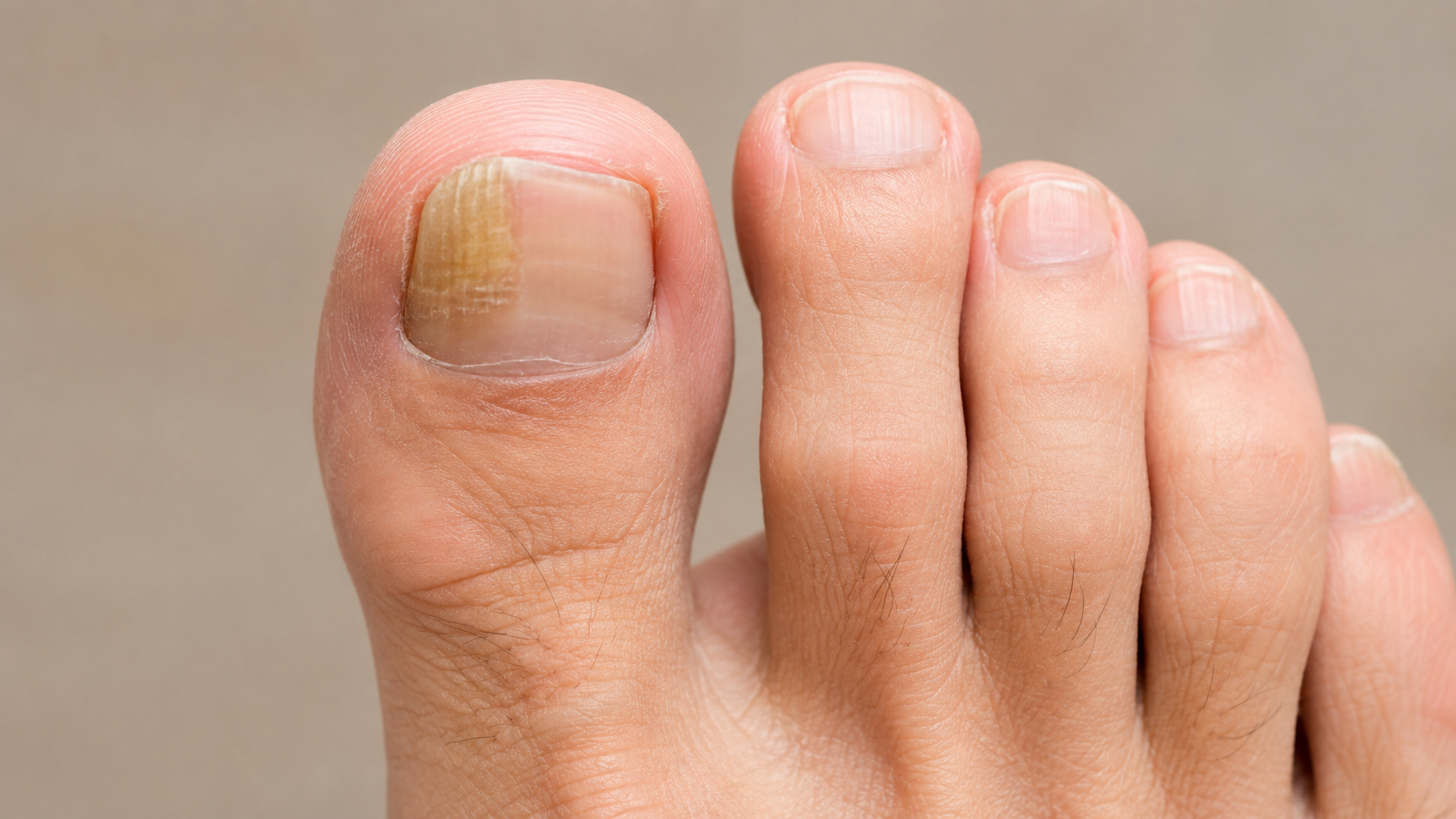 Nagelpilz behandeln – Nahaufnahme eines betroffenen Zehennagels